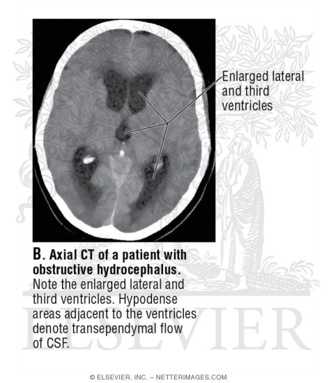 Axial CT of a Patient With Obstructive Hydrocephalus