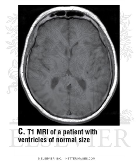 Watermarked preview of unlabeled image: T1 MRI of a Patient With Ventricles of Normal Size