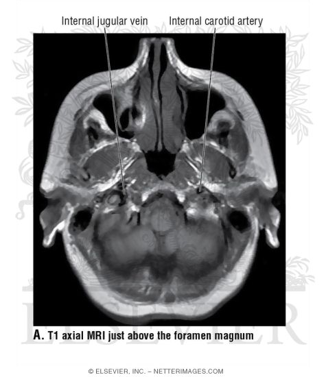 T1 Axial MRI Just Above the Foramen Magnum