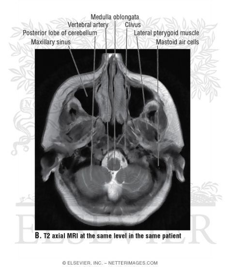 foramen magnum mri