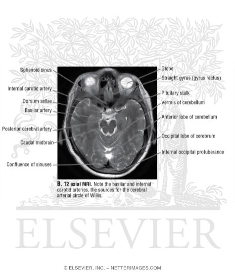 T2 Axial MRI Through the Upper Cerebellum