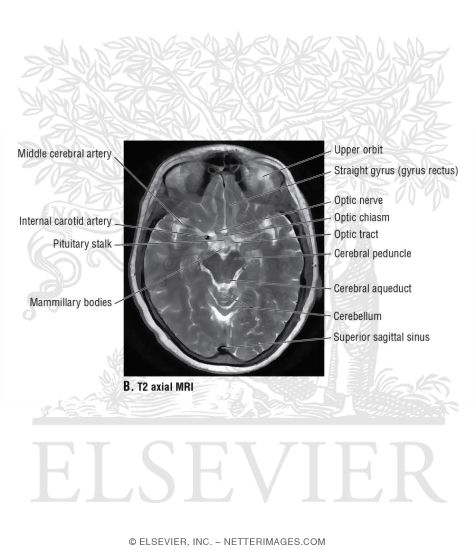 Watermarked preview of unlabeled image: T2 Axial MRI Though the Optic Chiasm