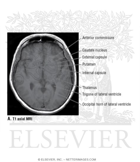 Watermarked preview of unlabeled image: T1 Axial MRI Through the Thalamus and Third Ventricle