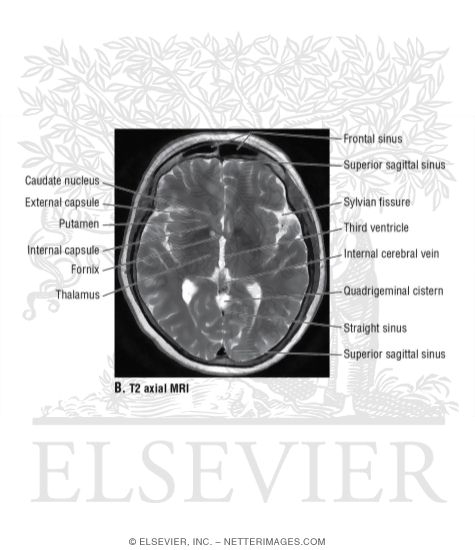 T2 Axial MRI Through the Thalamus and Third Ventricle