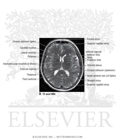 Watermarked preview of unlabeled image: T2 Axial MRI Through the Thalamus and Lateral Ventricles
