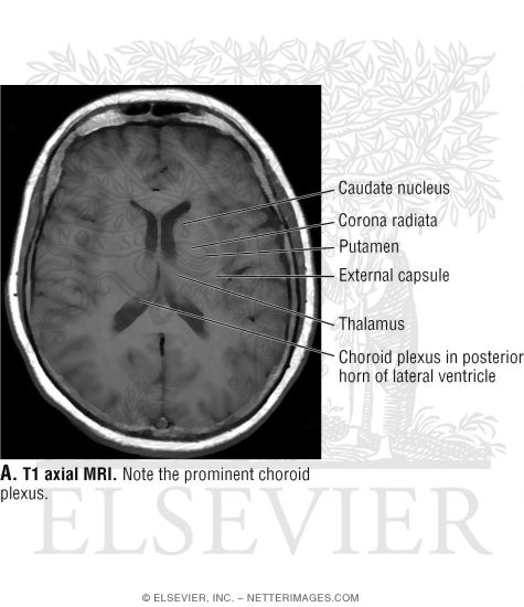 T1 Axial MRI Through the Lateral Ventricles