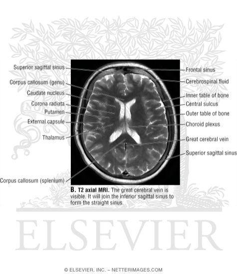 Watermarked preview of unlabeled image: T2 Axial MRI Through the Lateral Ventricles