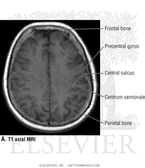 Watermarked preview of unlabeled image: T1 Axial MRI Through the Middle of the Cerebral Hemispheres