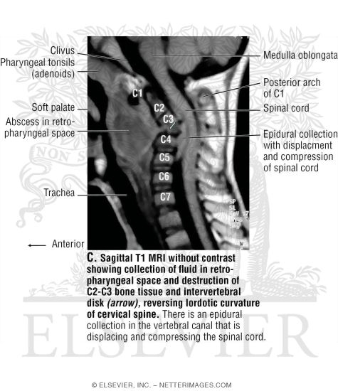 Watermarked preview of unlabeled image: Sagittal T1 MRI Without Contrast