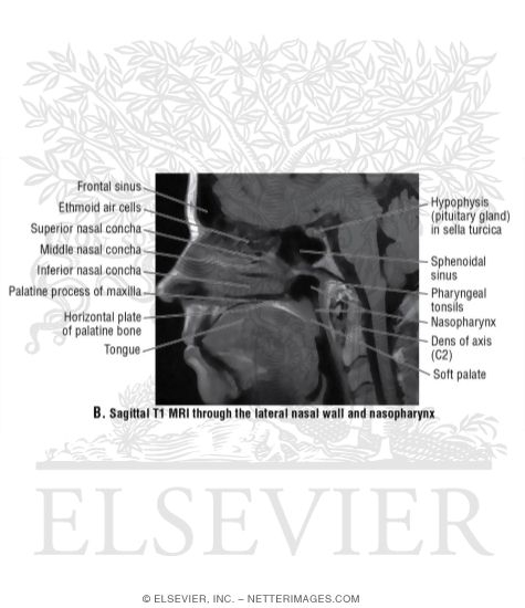 Watermarked preview of unlabeled image: Sagittal T1 MRI Through the Lateral Nasal Wall and Nasoparynx