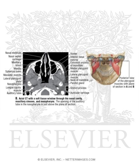 Axial CT With a Soft Tissue Window Through the Nasal Cavity, Maxillary Sinuses, and Nasopharynx