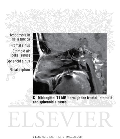 Watermarked preview of unlabeled image: Midsagittal T1 MRI Through the Frontal, Ethmoid, and Sphenoid Sinuses