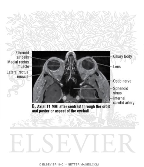 Watermarked preview of unlabeled image: Axial T1 MRI After Contrast Through the Orbit and Posterior Aspect of the Eyeball