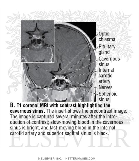 Watermarked preview of unlabeled image: T1 Coronal MRI With Contrast Highlighting the Cavernous Sinus
