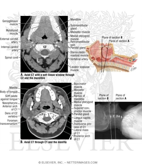 Axial CT at C2 and C1