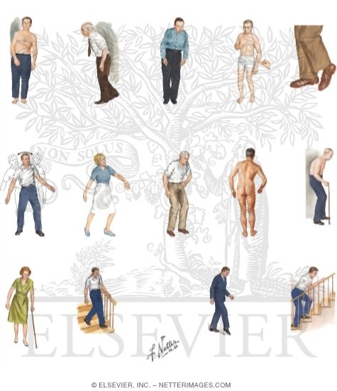 Gait Disorder Characteristics and Etiology