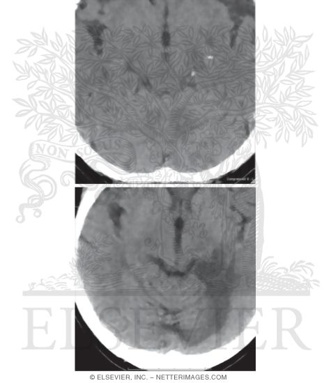 Watermarked preview of unlabeled image: Axial Noncontrast Brain CT