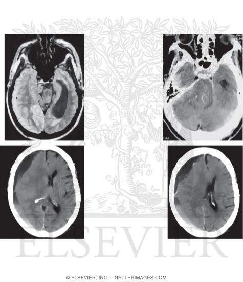 MR and CT Images Showing Cerebral Herniation Patterns