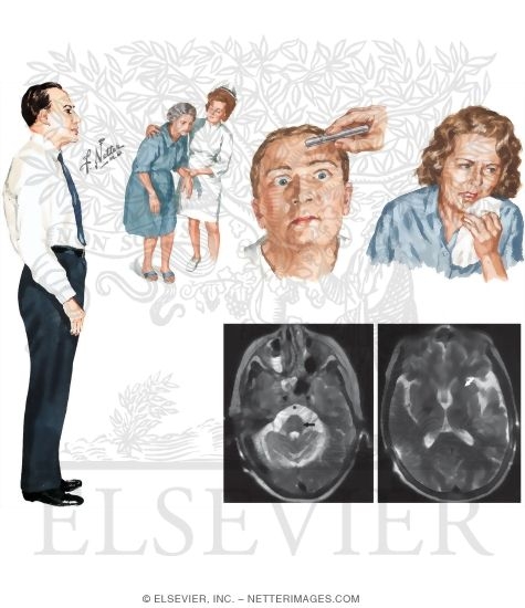 Progressive Supranuclear Palsy