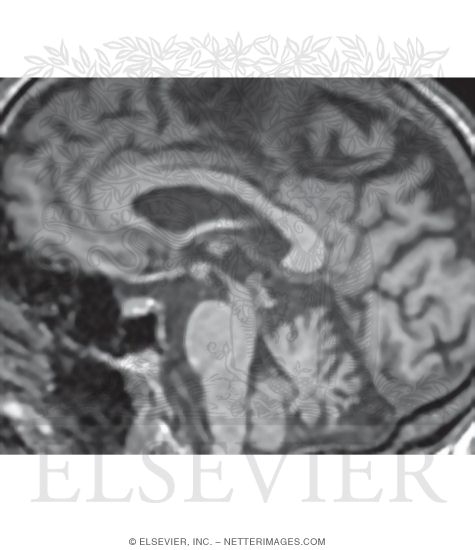 Watermarked preview of unlabeled image: Magnetic Resonance Imaging In Progressive Supranuclear Palsy