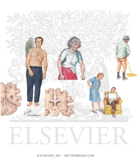 Watermarked preview of unlabeled image: Other Tauopathies. Corticobasal Degeneration and Frontotemporal Dementia