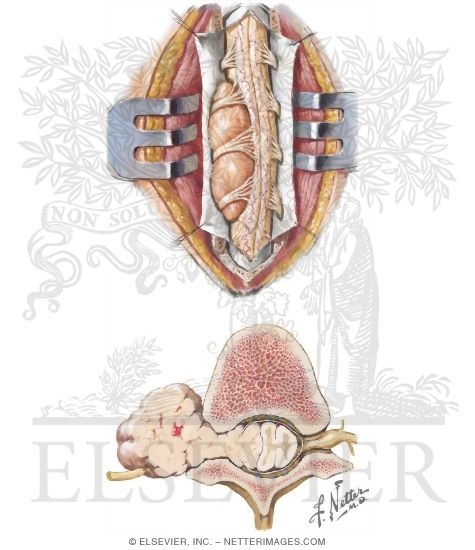 Intradural Extramedullary Tumors of Spinal Cord