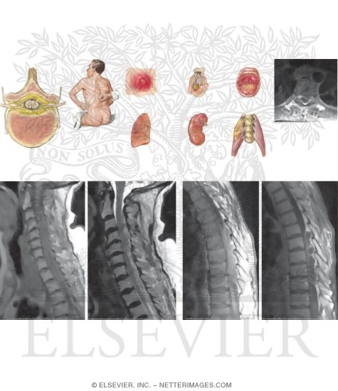 Watermarked preview of unlabeled image: Epidural Abscess and Epidural Hematoma