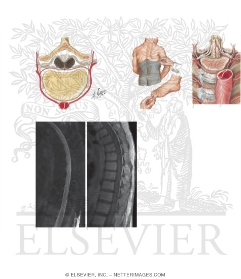 Watermarked preview of unlabeled image: Spinal Cord Infarction