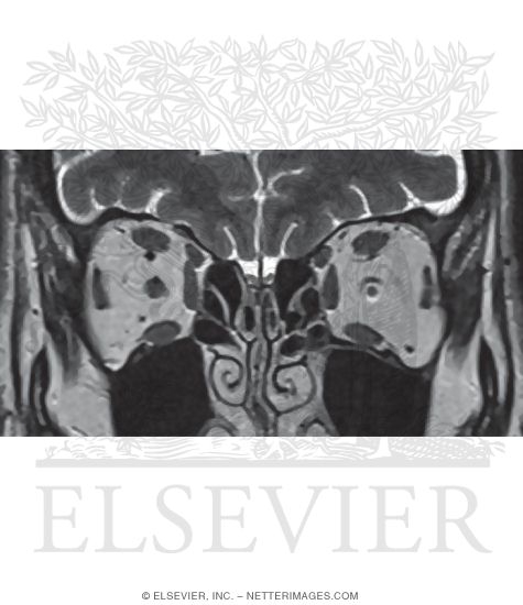 Optic Nerve Atrophy