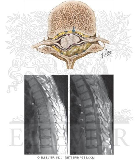 Spinal Epidural Abscess