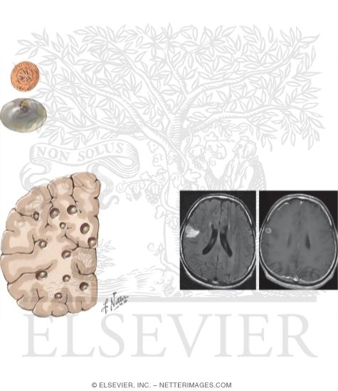 Cysticerosis