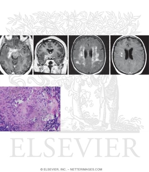 Watermarked preview of unlabeled image: Neurosarcoidosis: MRI and Pathology