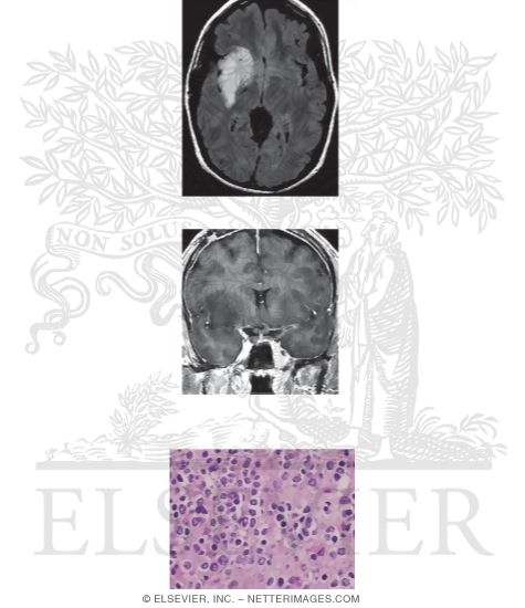 Oligodendroglioma