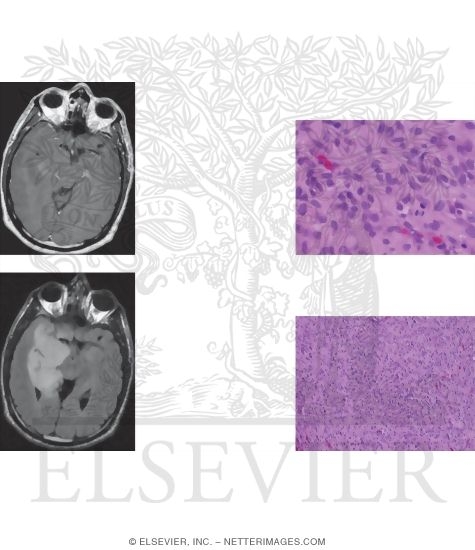Glioma, Anaplastic Astrocytoma