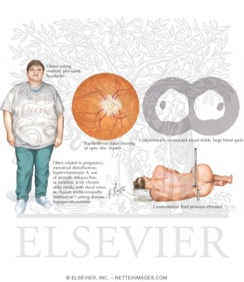 Pseudotumor Cerebri
