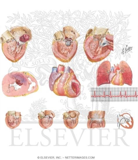 Watermarked preview of unlabeled image: Cardiac Embolism