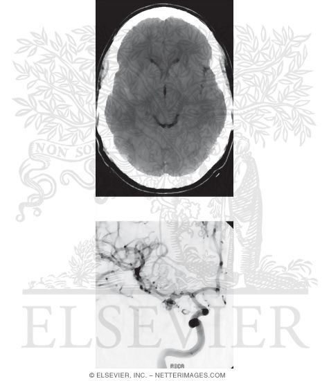 Watermarked preview of unlabeled image: Right Middle Cerebral Artery Aneurysm