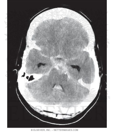 Basilar Artery Tip Aneurysmal Bleed