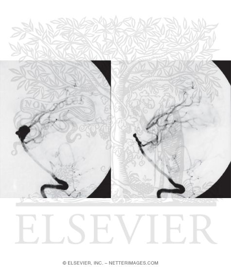 Basilar Artery Tip Aneurysm