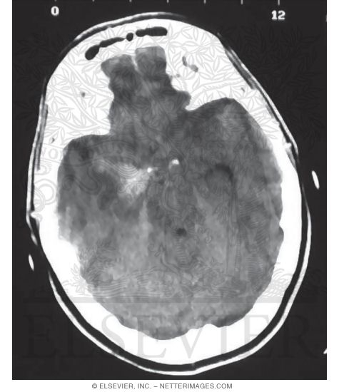 Subarachnoid Hemorrhage