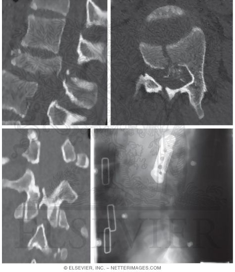 Burst Fracture: Lumbar Spine