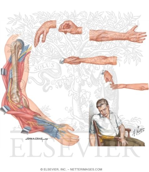 Wallpaper Radial Nerve Compression For iPhone