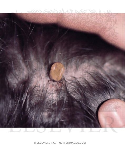Tick Embedded In Scalp Causing Tick Paralysis
