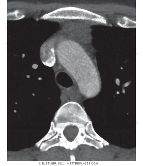 Thymoma