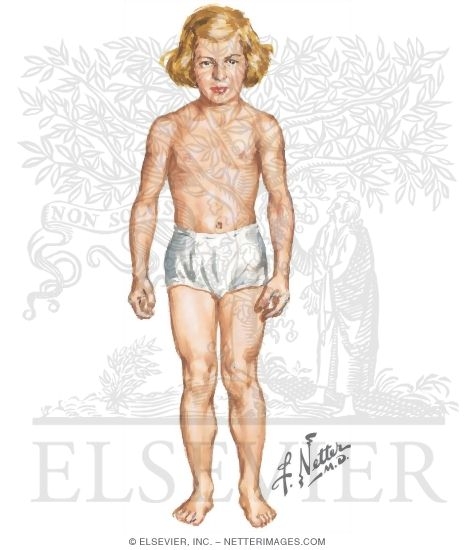 Myotonia Congenita (Thomsen Disease)