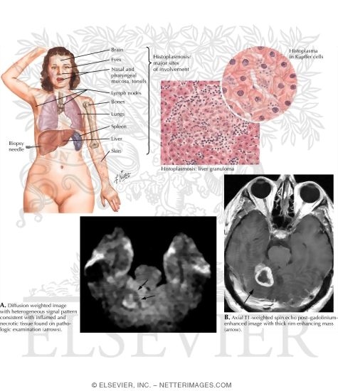 Watermarked preview of labeled image: Sarcoidosis, Brucellosis, Histoplasmosis