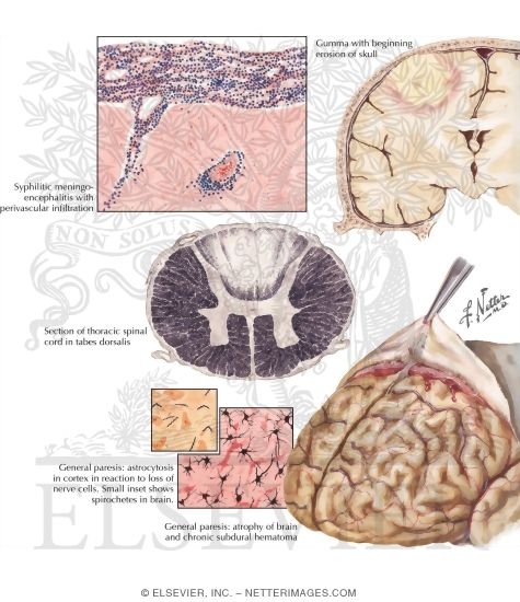 Watermarked preview of labeled image: Neurosyphilis