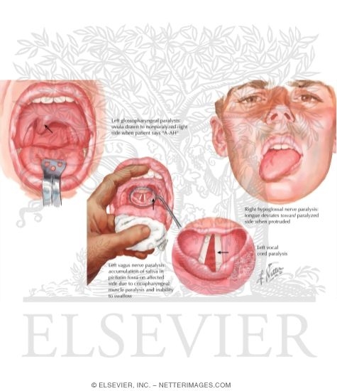 Watermarked preview of labeled image: Neurogenic Disorders of Mouth and Pharynx
