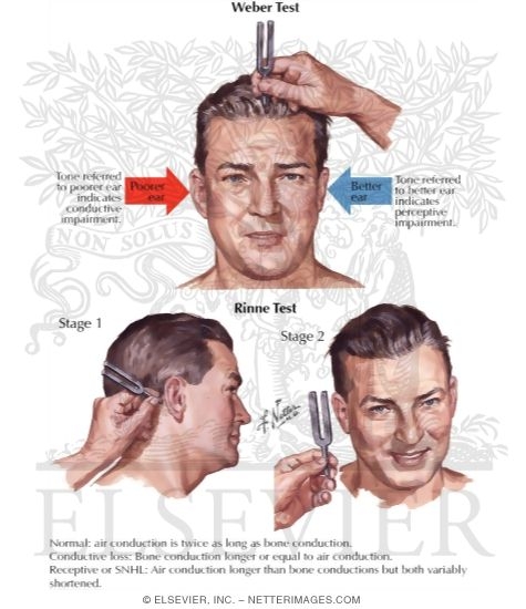 Auditory Nerve Testing: Weber and Rinne Testing