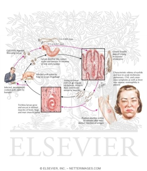 Watermarked preview of labeled image: Trichinosis